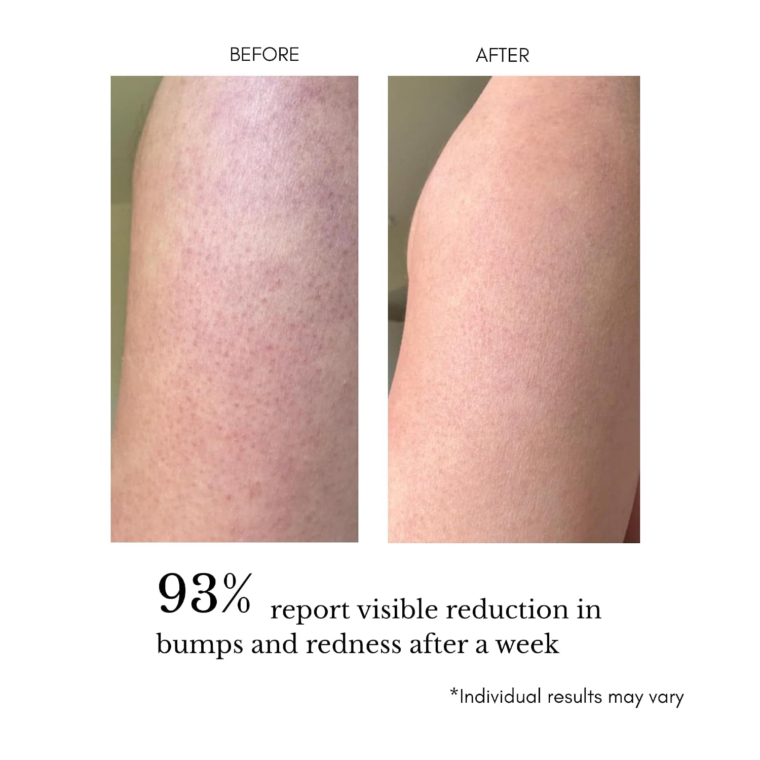 KP Treatment Body Serum (Triple Acid)