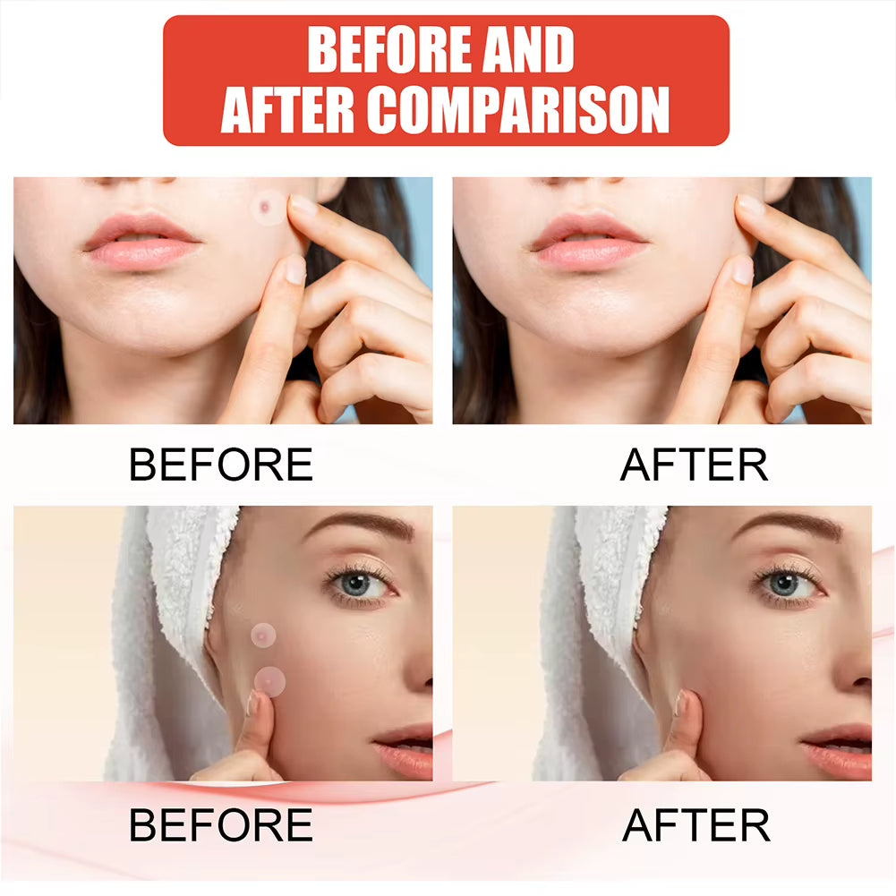 144Pcs/Set Face Skin Care Acne Pimple Patch 2 Sizes Invisible Professional Healing Absorbing Spot Sticker Covering for Men Women
